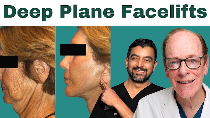 Transforming Your Face with a Deep Plane Facelift