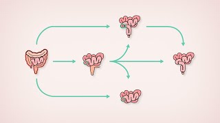 Surgical treatment for Ulcerative Colitis | Patient Education | TVASurg