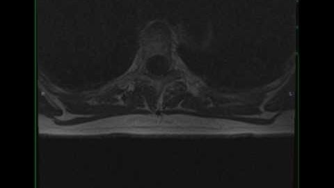 Meningioma, Thoracic Spine