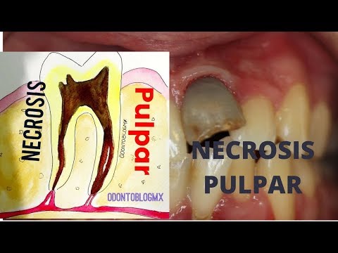 Vídeo: Necrosis Pulpar: Síntomas, Pruebas, Causas, Riesgos Y Tratamientos