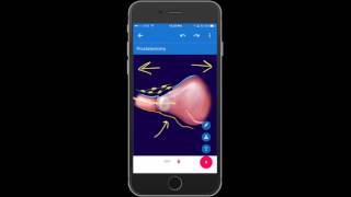 Drawmd Demo - Prostatectomy