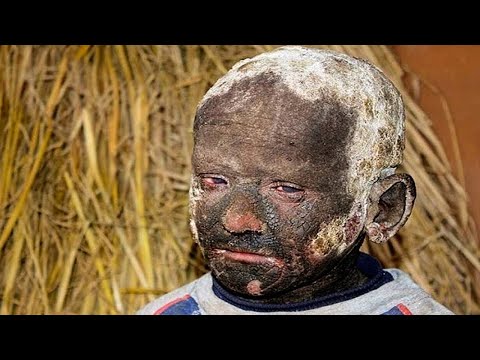 Video: Das Kind Wird Durch Eine Seltene Krankheit 