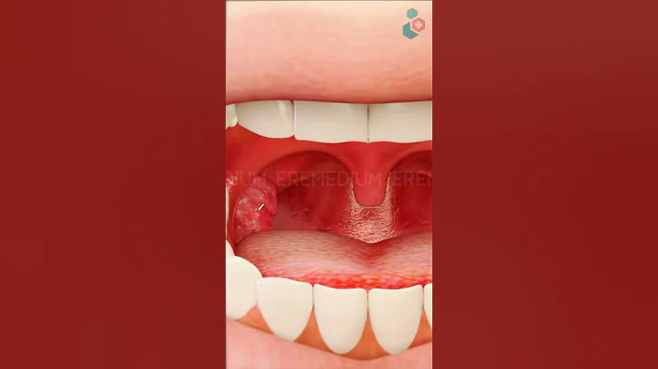 Tonsil Removal Surgery ↪ 3D Medical Animation #Tonsil #Tonsillectomy #Surgery #Shorts