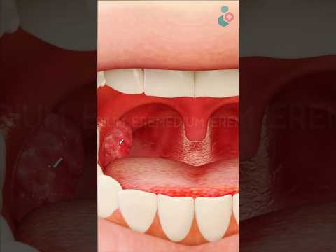 Tonsil Removal Surgery ↪ 3D Medical Animation #Tonsil #Tonsillectomy #Surgery #Shorts