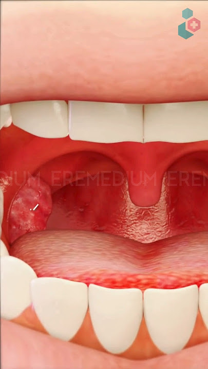 Tonsil Removal Surgery ↪ 3D Medical Animation #Tonsil #Tonsillectomy #Surgery #Shorts