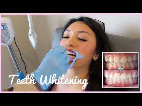 TEETH WHITENING EXPERIENCE | First time getting teeth whitened