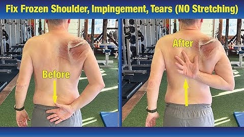 Fix Frozen Shoulder & Impingement - (No Stretching or PT Exercises)
