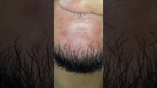 Beard hair Satisfying #massage therapy #ingrownhair #haircare #relax #hairgrowth #shorts #video