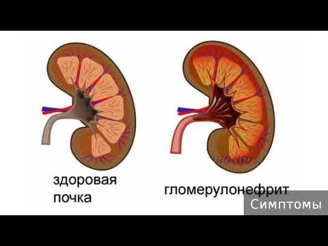 Видео: Постстрептококов синдром: симптоми, лечение и профилактика