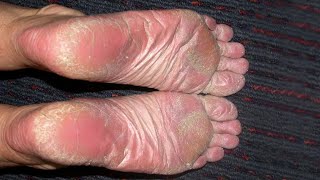 Stepping Towards Relief: Effective Ways to Treat Psoriasis on Your Feet