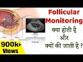 Follicular Monitoring क्या होती है और क्यों की जाती है ? | All about Follicular Monitoring
