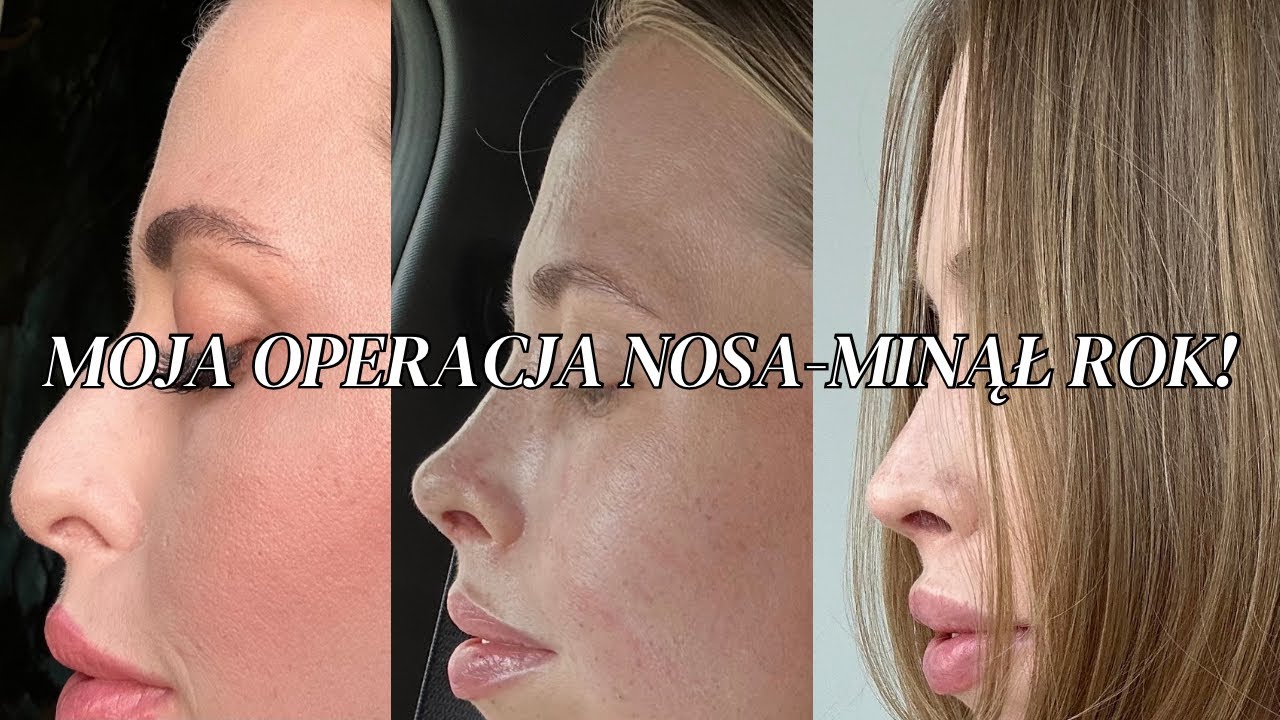 Operacja nosa-cena, minusy operacji, efekty po roku!