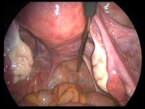Laparoscopic Gynecologic Anatomy