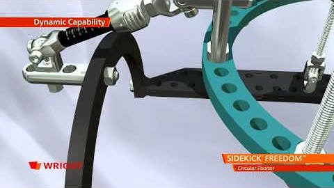 SIDEKICK™ FREEDOM™ Circular Fixator Animation