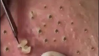 How to Removal Cystic Acne Treatment Blackheads On The Face Easy (Part 7)