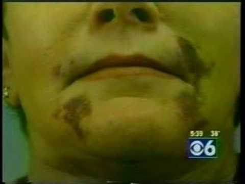 V-Beam for Cosmetic Surgery Bruising by Dr. Edwin ...