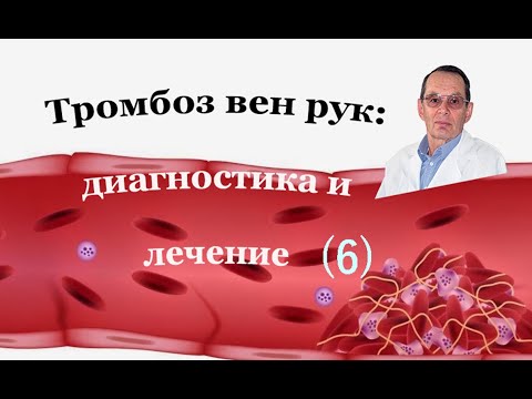 Видео: Выпуклые вены рук: причины и лечение