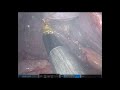 Robotic cholecystectomy ahad khan  md