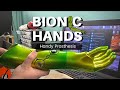 Bionic Arm Prosthetics - Motorica