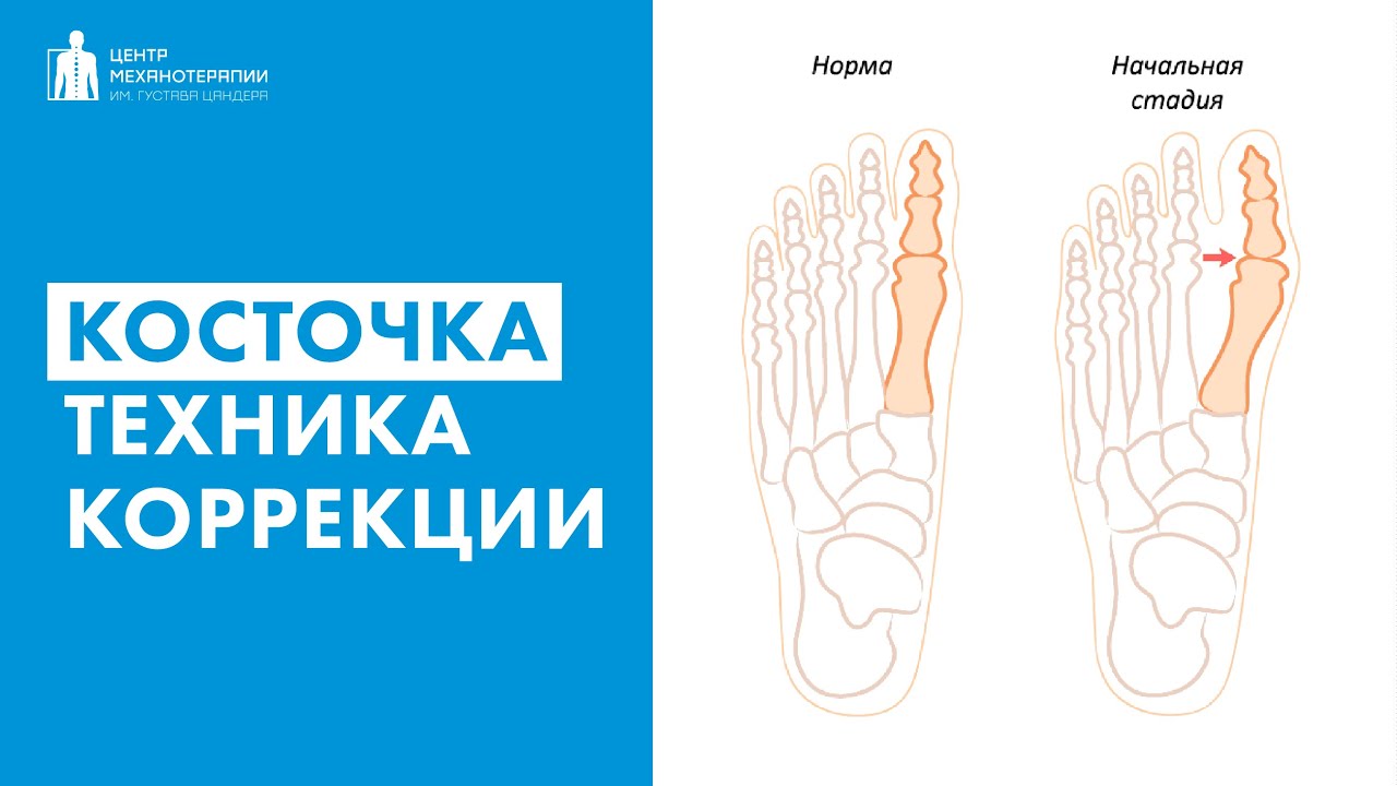 Косточка на стопе (халюс вальгус) | техника для профилактики и ...