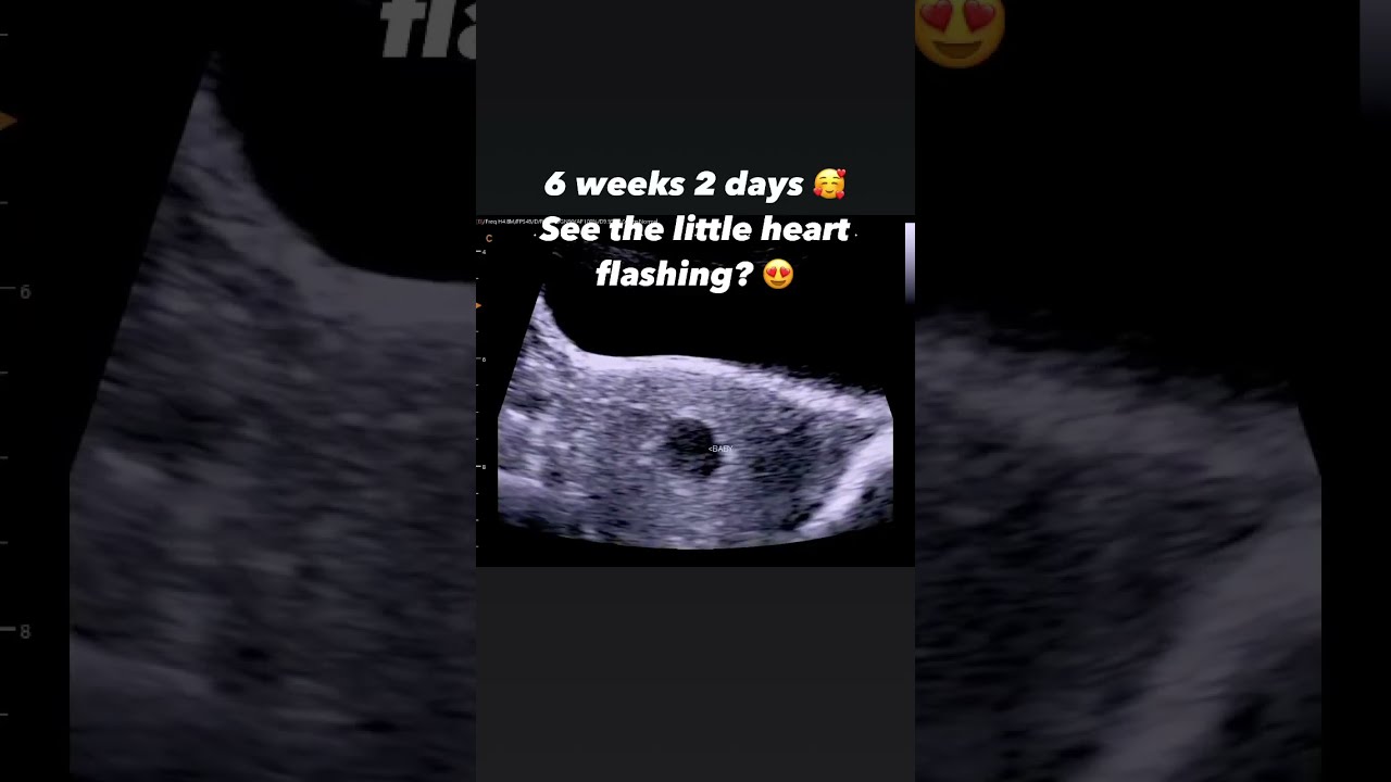6 Weeks 2 Days Jerbearimaging Tinybaby Pregnant 6weekultrasound