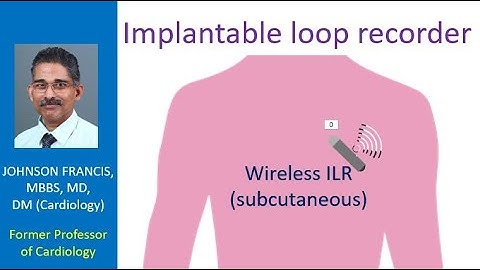 Implantable loop recorder