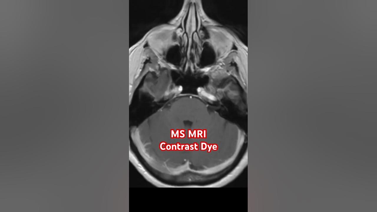 ms-mri-contrast-dye-youtube