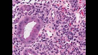 CMV colitis