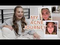 My Acne Journey!