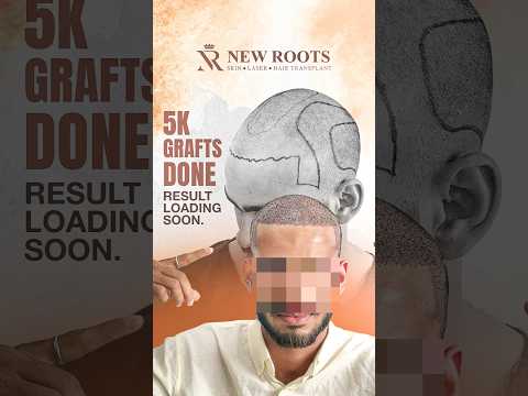 5000 Grafts Hair Transplant in Lucknow | Cost and Results #hairtransplant #lucknow #shorts