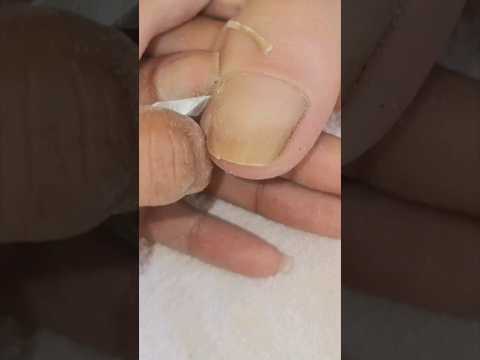 ظفر القدم الغارز اظافر ظفر ترميم قصيرة