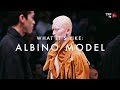 What It's Like: Albino Model