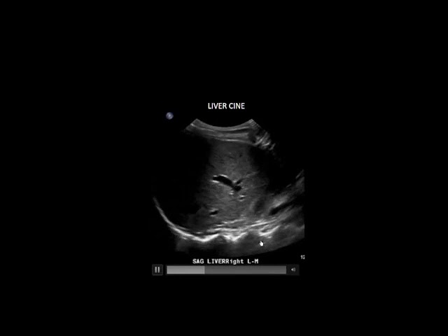 Ultrasound of Acute Right Upper Quadrant Pain Ultrasound Video class=