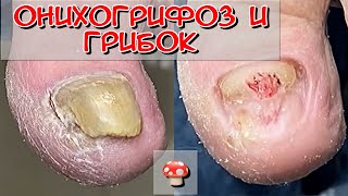 онихогрифоз / грибок / микоз / толстый ноготь на большом пальце / трихофитон / педикюр