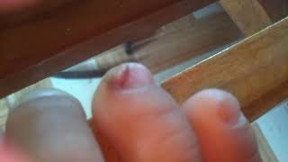 Toenails broken to the point of pain
