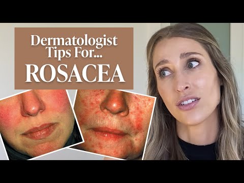 ቪዲዮ: Papulopustular rosacea የሚያሳክክ ነው?