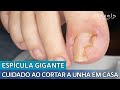 CUIDADO AO CORTAR A UNHA EM CASA | ESPÍCULA GIGANTE