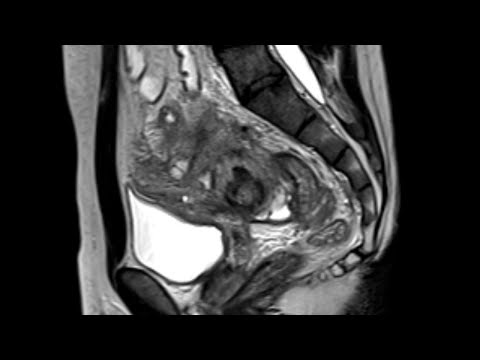 Video: MM2S: Personalizēta Medulloblastomas Pacientu Diagnoze Un Modeļu Sistēmas