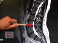 Low Back Pain Part 8: Spinal Stenosis