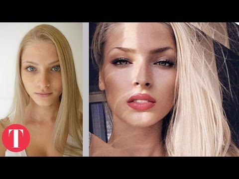 Video: Alena Shishkova: antes y después de la cirugía