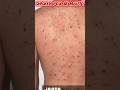 Chicken Pox Ne Le Li Jaan 😱 Galti Jo Aapko Nahi Karni Chahiye#simplyscience #facts #shorts