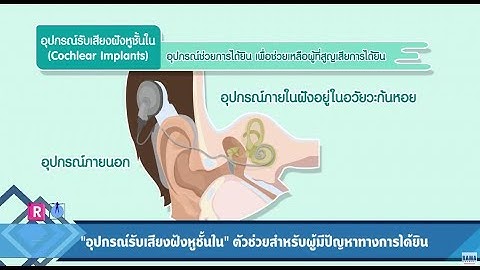 “อุปกรณ์รับเสียงฝังหูชั้นใน"กับผู้มีปัญหาการได้ยิน : Rama Square ช่วง ปากสวย–โสตใส 28 มิ.ย.60 (3/4)