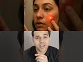 "Acne Ka Asli Gunehgaar: Sab Kuch Galat Sikha Gaya Hai!”