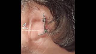 Ear prosthesis