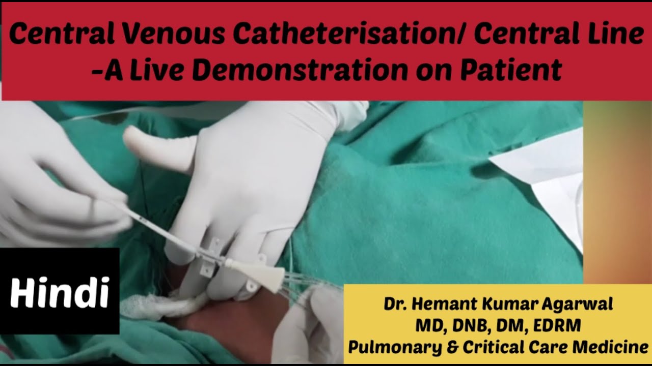 Central Venous Catheterisation (HINDI)/ Central Line/ Sub clavian Vein