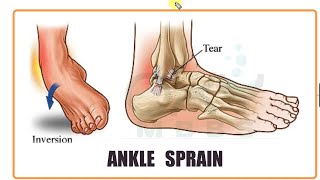 ORTHOPAEDICS- Ankle Sprain