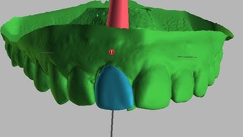 How to recreate Acuris abutment in Blue Sky Plan