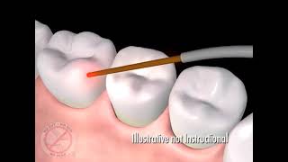 Laser Assisted New Attachment Protocol (LANAP)
