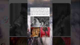 man born with second face in the back of his head