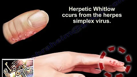 Herpetic Whitlow - Everything You Need To Know - D...